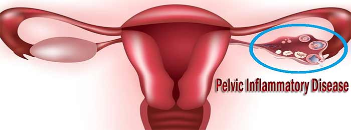 درمانی پیشگیری از عفونت رحم