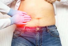 آب آوردن شکم+ علل ایجاد ودرمان بیماری